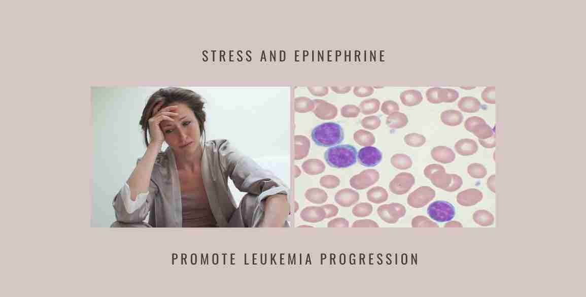 Stress Epinephrine Promote Leukemia Progression