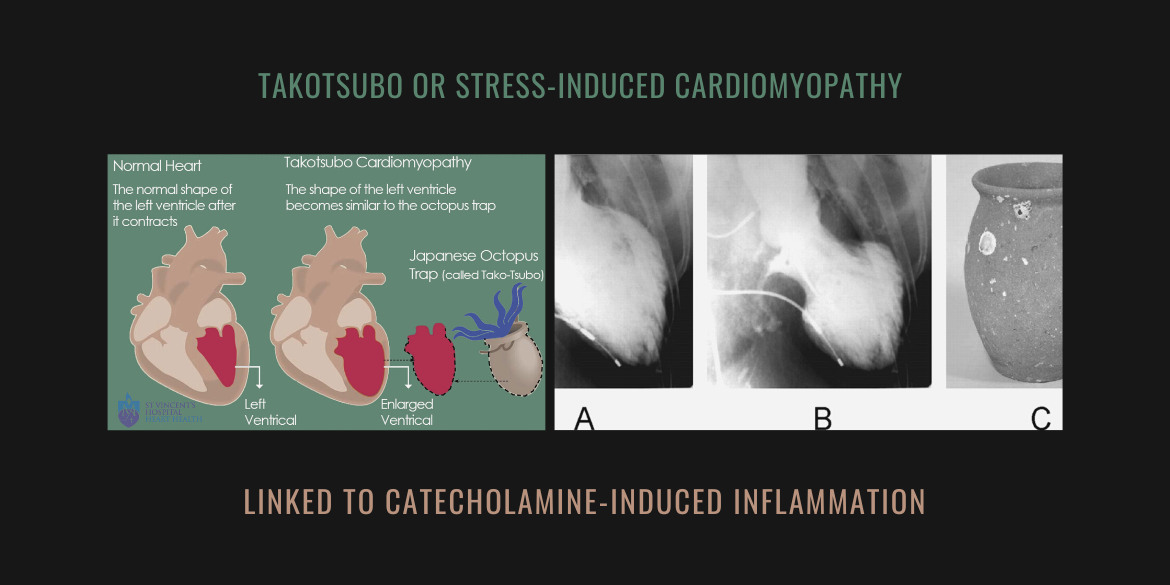 Early Recognition of Apical Ballooning Syndrome by Global