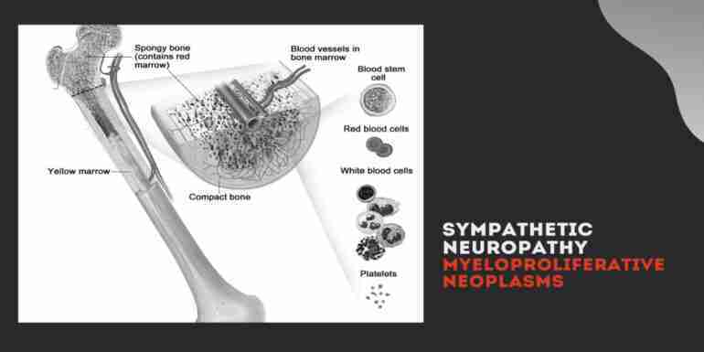 Sympathetic Neuropathy & Myeloproliferative Neoplasms