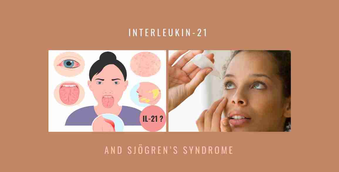 evidence implicating sjogrens syndrome IL-21