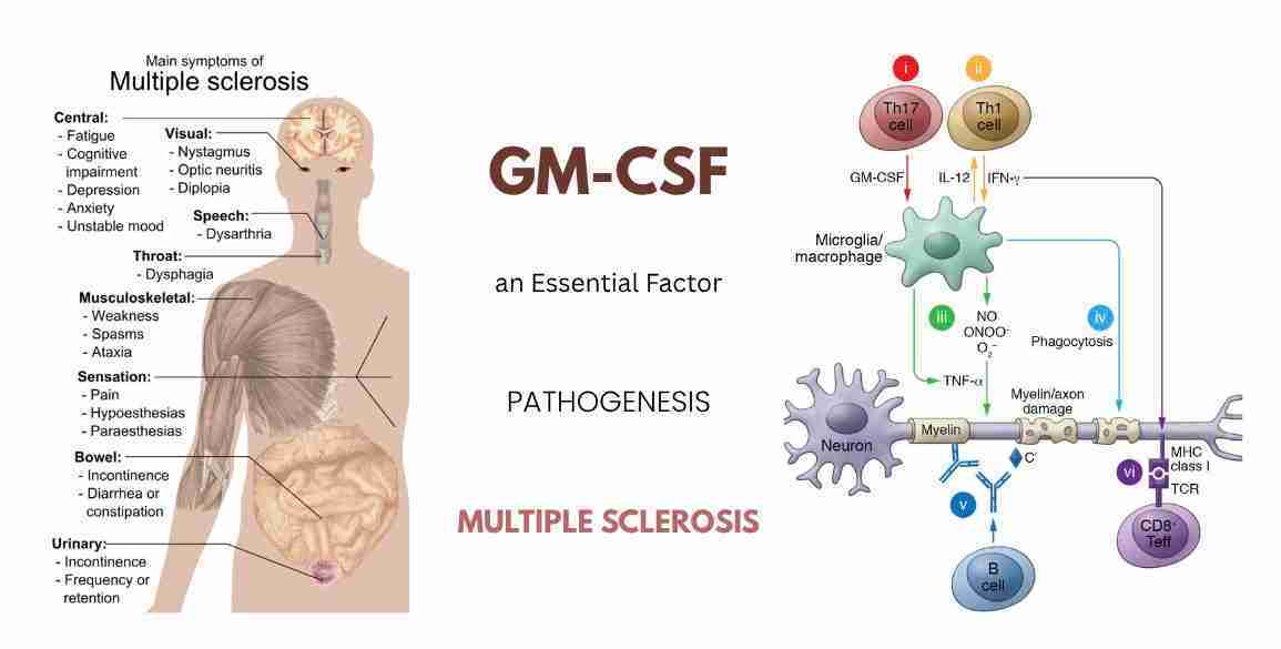 GM-CSF Pathogenesis Multiple Sclerosis