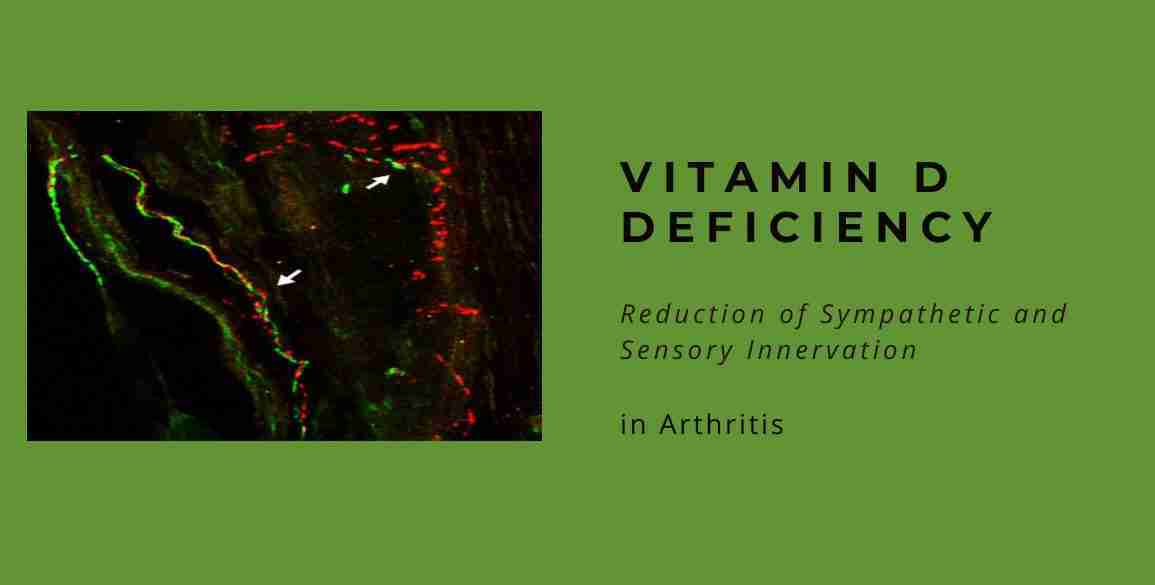 vitamin d deficiency sympathetic arthritis