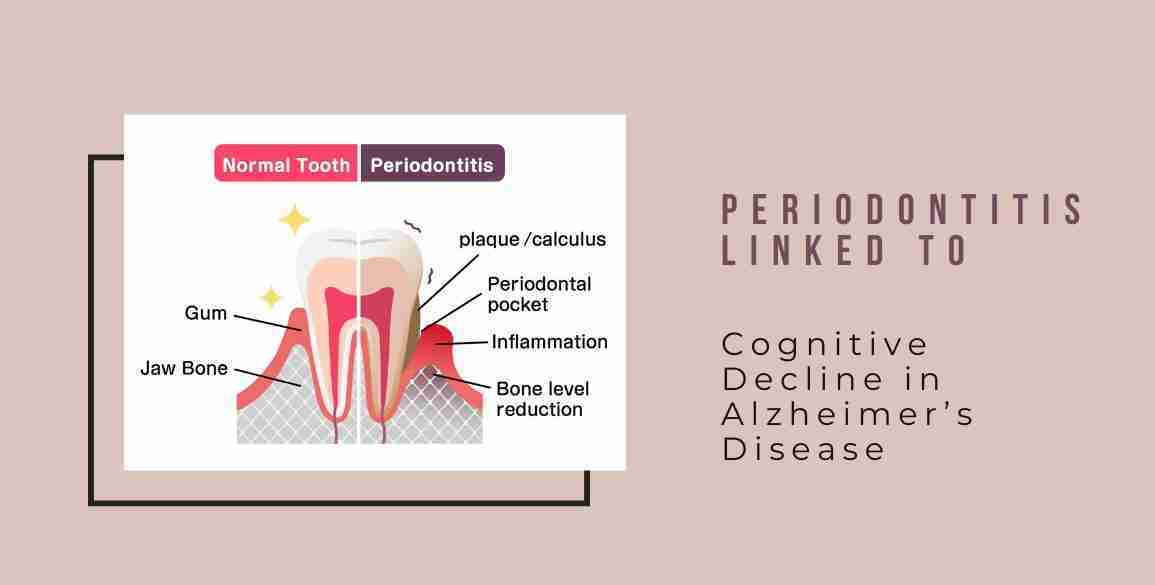 Periodontitis Cognitive Decline Alzheimers
