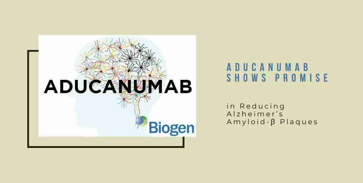 Aducanumab Shows Promise Alzheimers