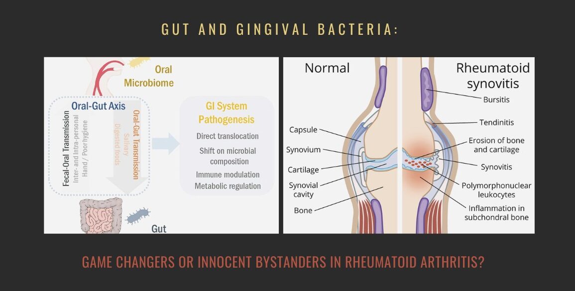 Gut Bacteria Game Changers Arthritis