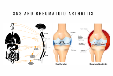 Sympathetic System Dysfunction Rheumatoid Arthritis