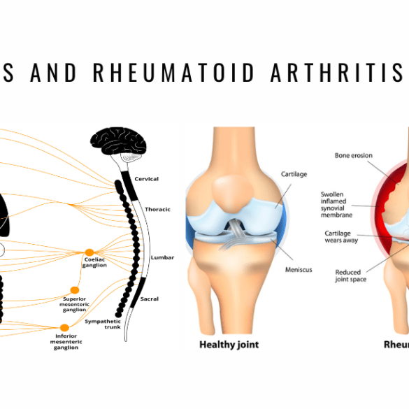 Sympathetic System Dysfunction Rheumatoid Arthritis