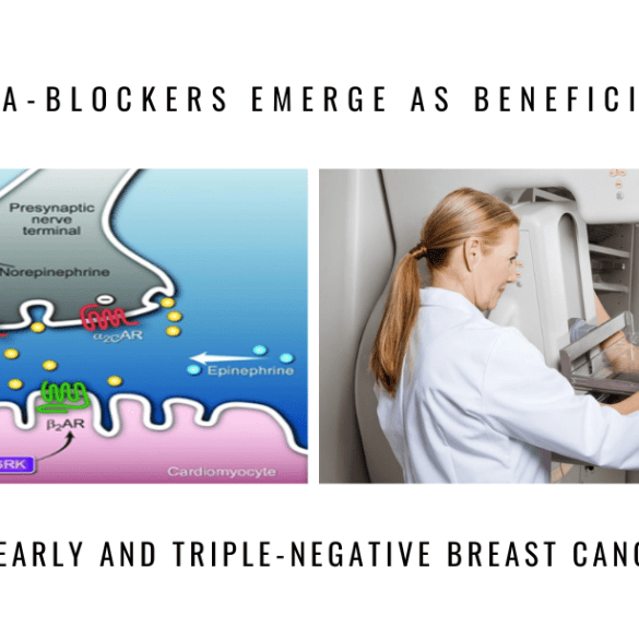 beta blockers benefactors early breast cancer
