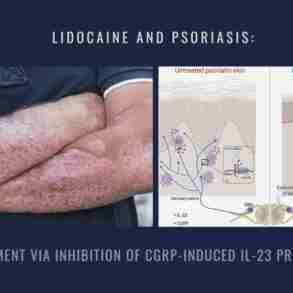 Lidocaine and Psoriasis Inhibition CGRP IL-23 Production